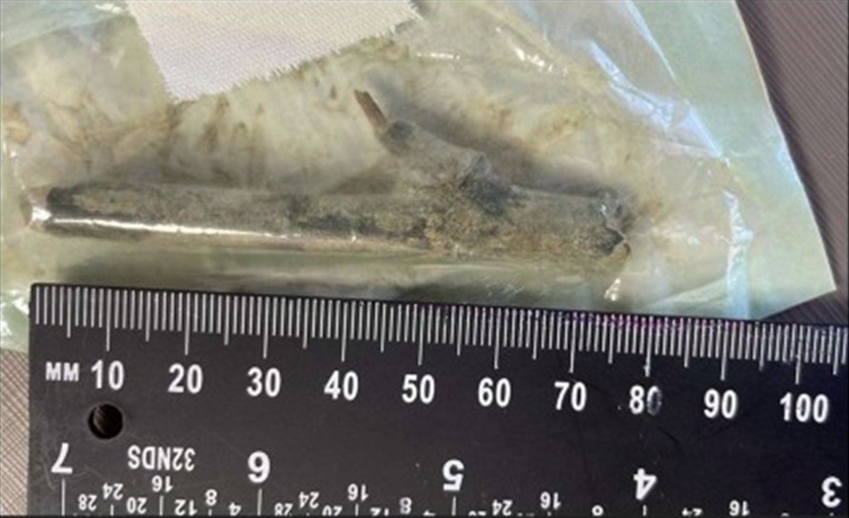 A história do paciente que ficou com pedaço de madeira de 8 cm dentro da perna após erro médico em SC a-historia-do-paciente-que-ficou-com-pedaco-de-madeira-de-8-cm-dentro-da-perna-apos-erro-medico-em-sc