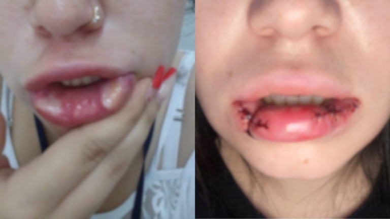 ‘quase-perdi-a-boca’:-mulher-tem-necrose-apos-receber-pmma-sem-saber-em-sc;-empresaria-e-condenada