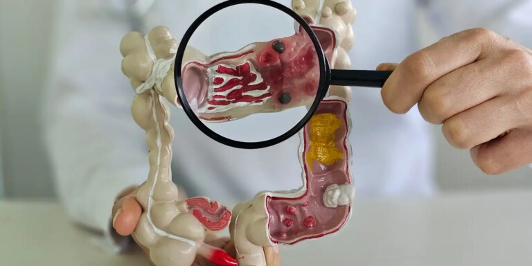 Em 13 anos, doença inflamatória intestinal cresce 5 vezes no Brasil em-13-anos,-doenca-inflamatoria-intestinal-cresce-5-vezes-no-brasil