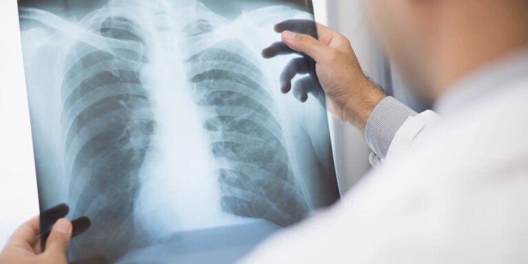 Anvisa aprova novo medicamento para câncer de pulmão avançado anvisa-aprova-novo-medicamento-para-cancer-de-pulmao-avancado
